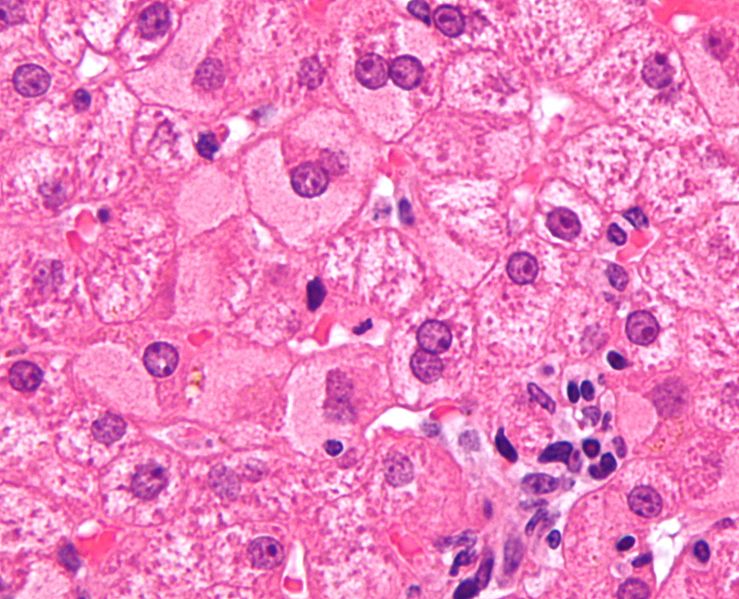 739px-Ground_glass_hepatocytes_high_mag_cropped_2 28 lipca Światowy Dzień Wirusowych Zapaleń Wątroby (WZW)