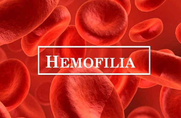 Hemofilia – co wiemy o tej chorobie? BIZNES, Farmacja - Odpowiedzi na pytanie o hemofilię, postawione podczas sondy ulicznej mogą zaskakiwać. Pokazują, że Polacy nie mają dużej wiedzy na jej temat, chociaż jest to jedna z najczęstszych skaz krwotocznych i najwcześniej rozpoznawanych chorób genetycznych.