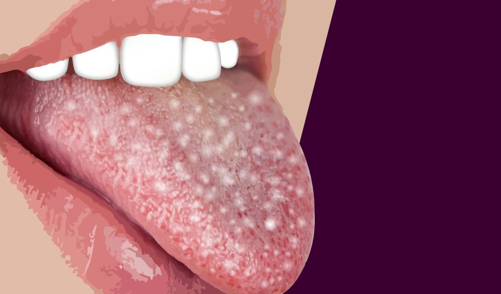 dental-300-dpi-pixabay.com_ Biały nalot, ból i uczucie dyskomfortu w jamie ustnej