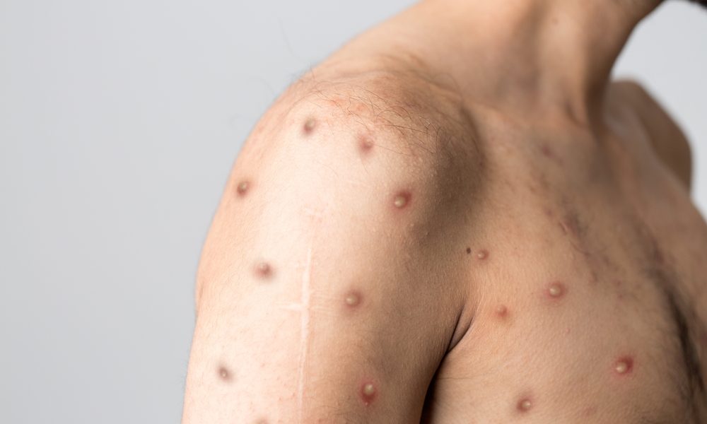 Monkeypox,New,Disease,Dangerous,Over,The,World. Obawiasz się małpiej ospy? Problem dotyka głównie młodych mężczyzn